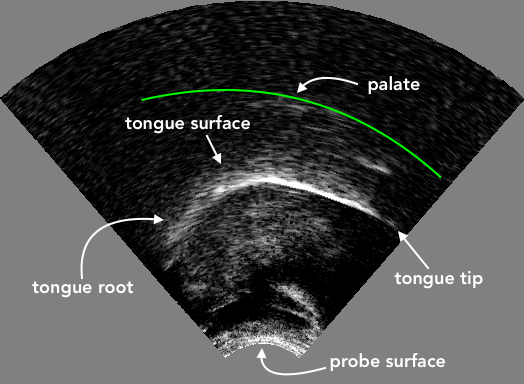 An ultrasound image showing a mid-sagittal view of the tongue. The white curved stripe in the image indicates where the ultrasonic waves have been reflected by the air above the tongue. The tongue surface corresponds to the lower edge of the white stripe. In this image, the tongue tip is located on the right. The green curve approximates the location of the palate.